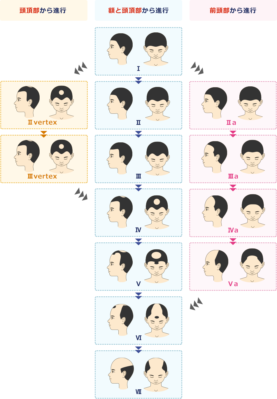 頭皮レベル（進行度）のタイプ（男性）